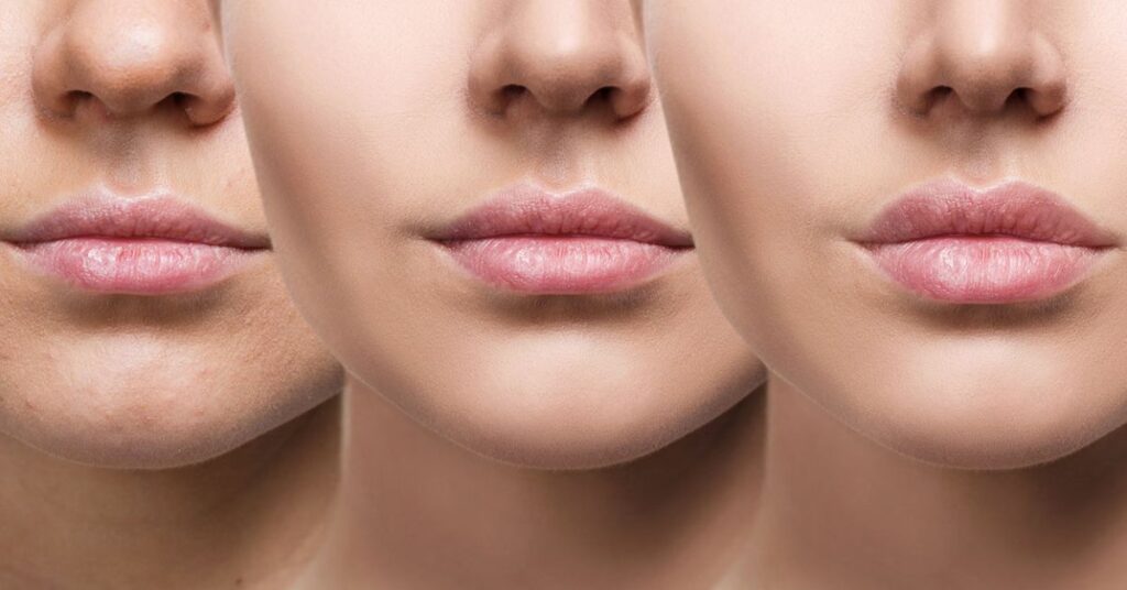Benefits of Applying the best filler for lips