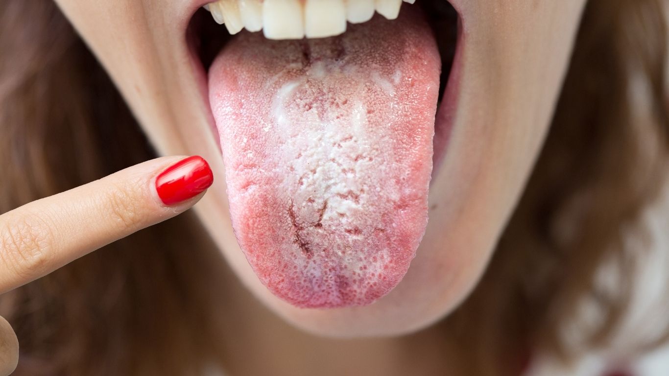Treat Oral Thrush Naturally