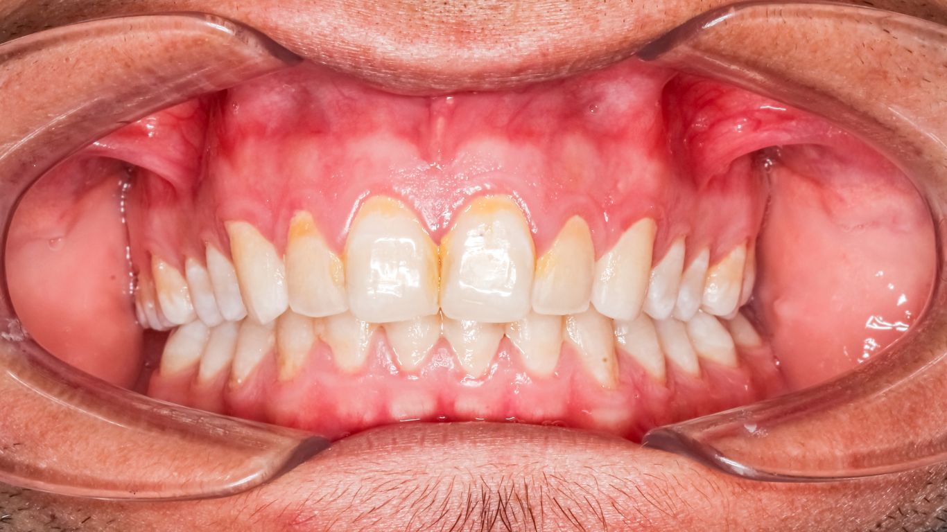 supplements for tooth decay